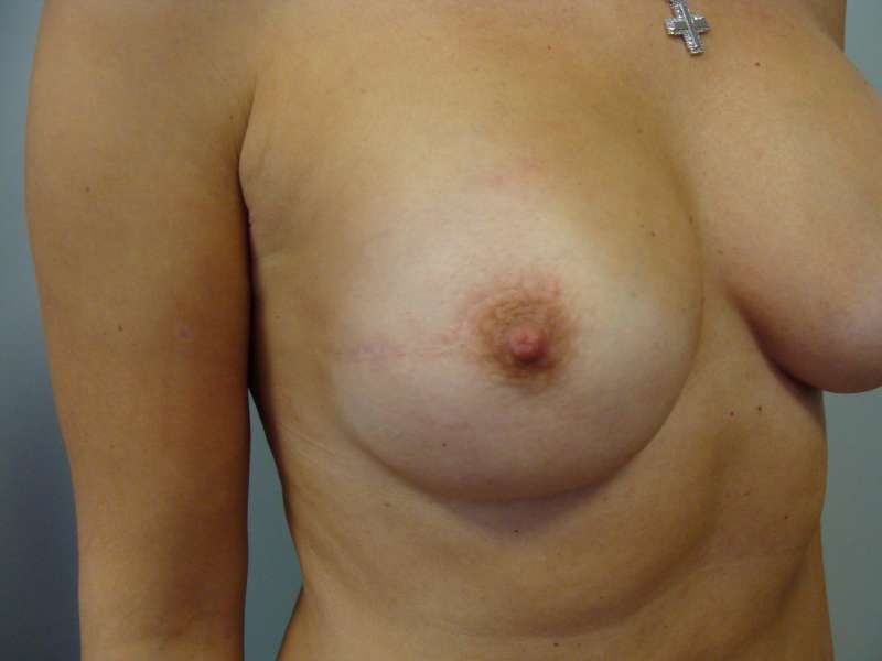 5. Reconstruction of both breasts with a prosthesis